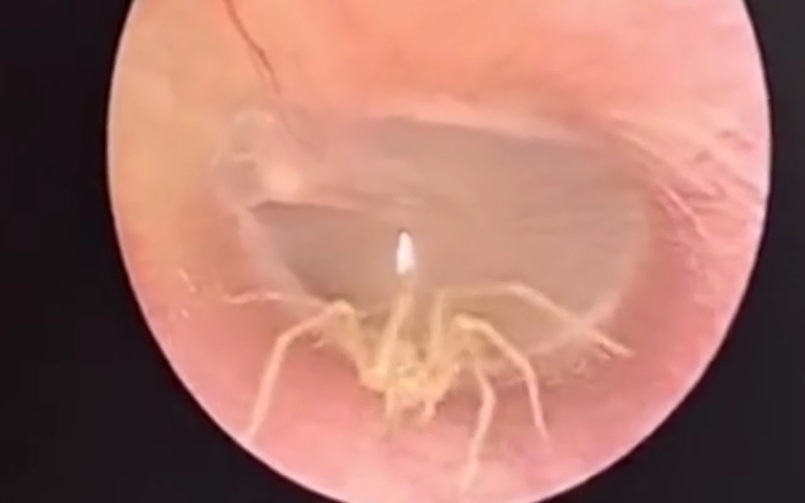 Video: Sởn gai ốc với cảnh nhện bò trong ống tai người phụ nữ